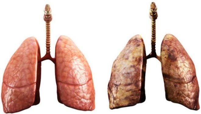 Javier Cortés descubre la cura contra el cáncer de pulmón