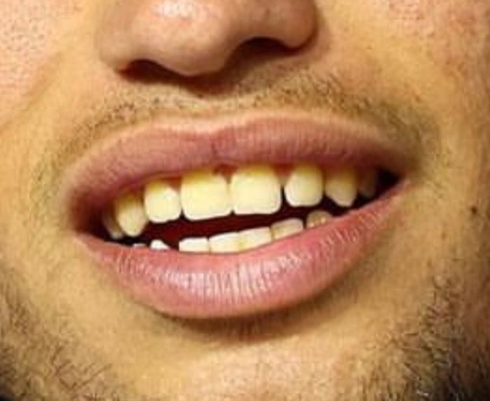 Carlos Alcaraz y sus dientes