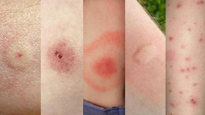 La nueva pandemia: Dermatitis del viajero